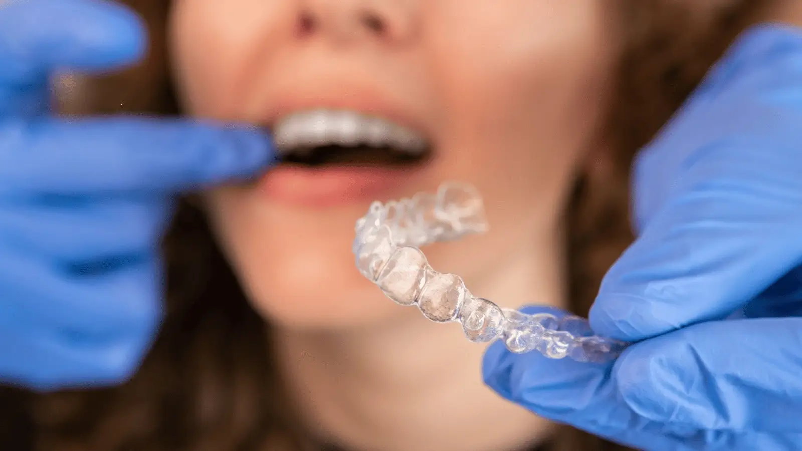 Mani in guanti blu reggono un allineatore trasparente davanti alla bocca sorridente di una donna dai capelli castani