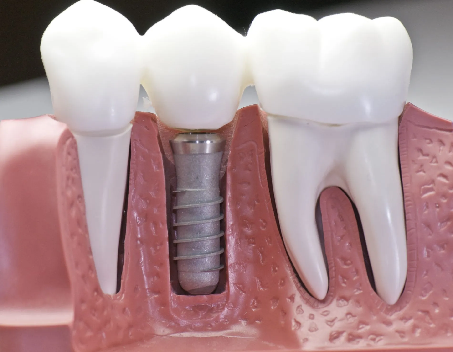 Modello in sezione di impianto dentale in titanio con corona bianca tra due denti naturali, su gengiva rosa