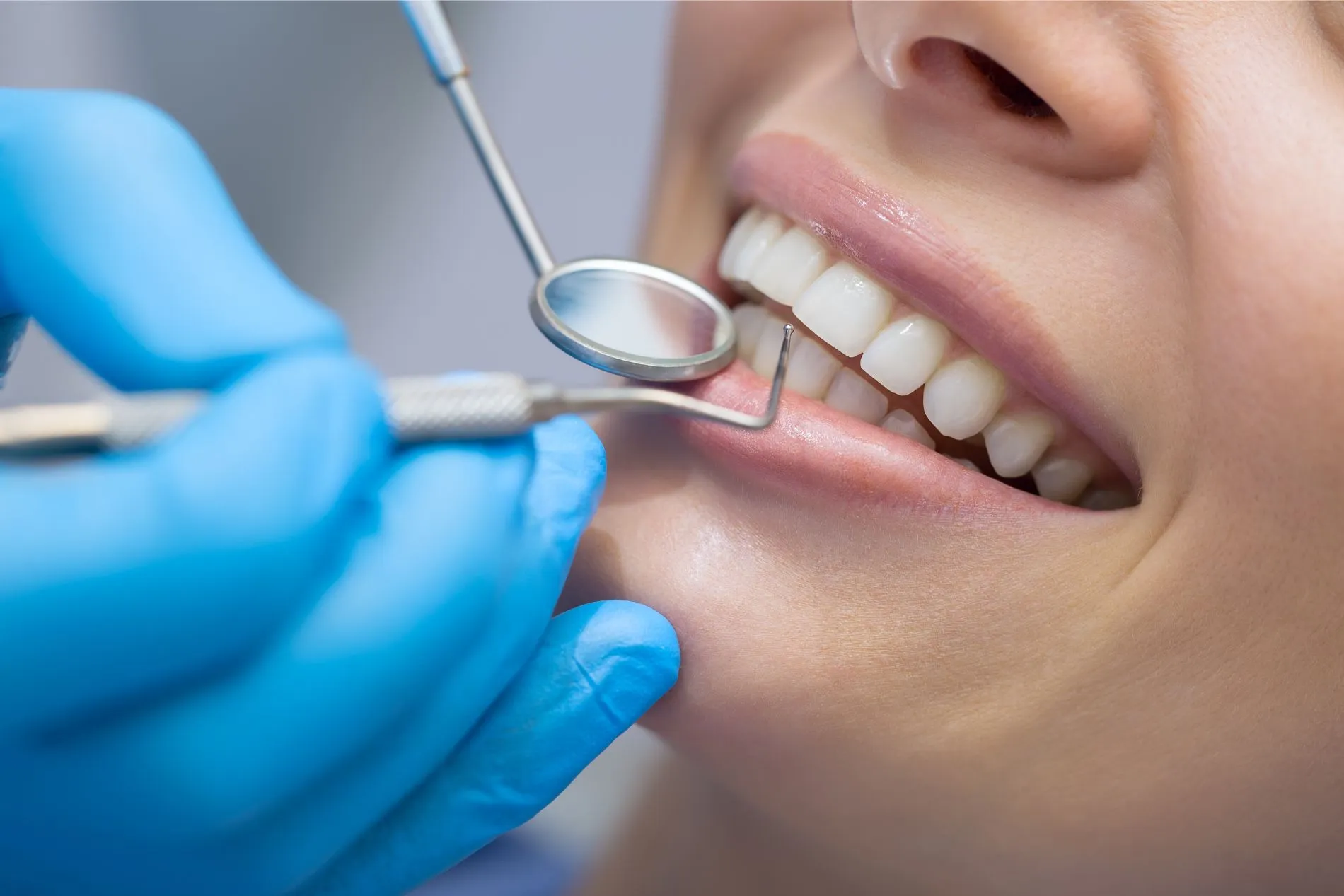 Mani in guanti blu esaminano con specchietto e sonda metallica il sorriso di una donna dai denti bianchi e allineati